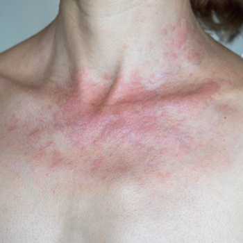 Sunlight Allergies: Can You Develop Them In Adulthood?