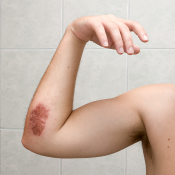 How to Tell If a Wound is Healing Correctly