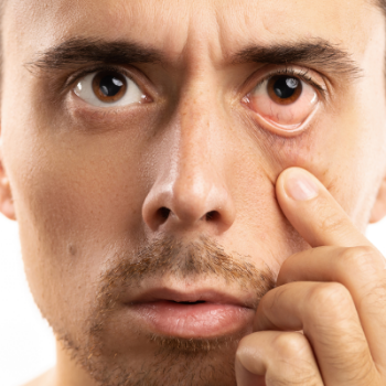 Is Pink Eye Contagious? What You Should Know