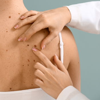 5 Signs You Should Get a Mole Checked By a Doctor