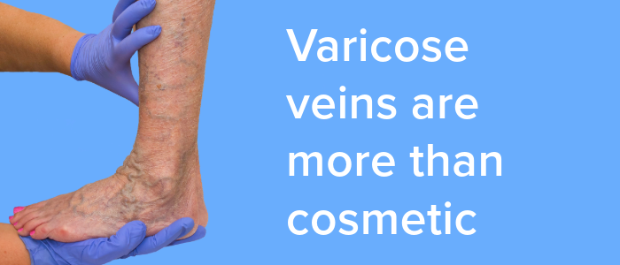 Varicose veins on a patient’s leg showing signs of swelling and discoloration