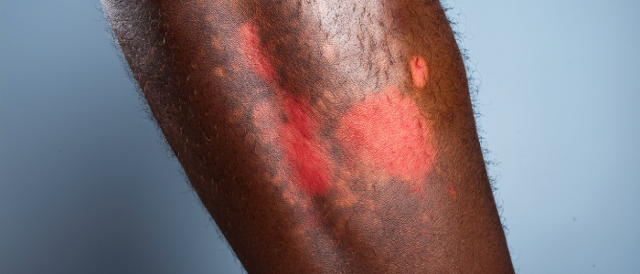 cellulitis on the leg with skin layers affected by infection.
