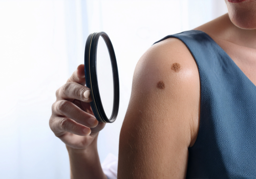 ABCDEs of Skin Cancer: How to Spot Dangerous Moles Early